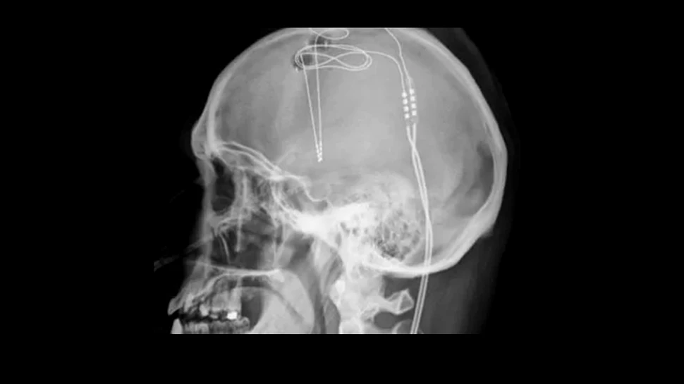 Premieră medicală în SUA. Implanturi cerebrale folosite pentru a trata dependenţa de opioide