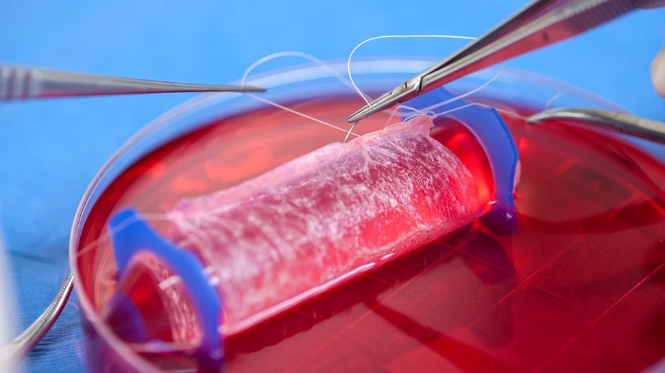 Primele vagine artificiale, realizate în laborator, au fost transplantate cu succes unor tinere care sufereau de o afecţiune rară