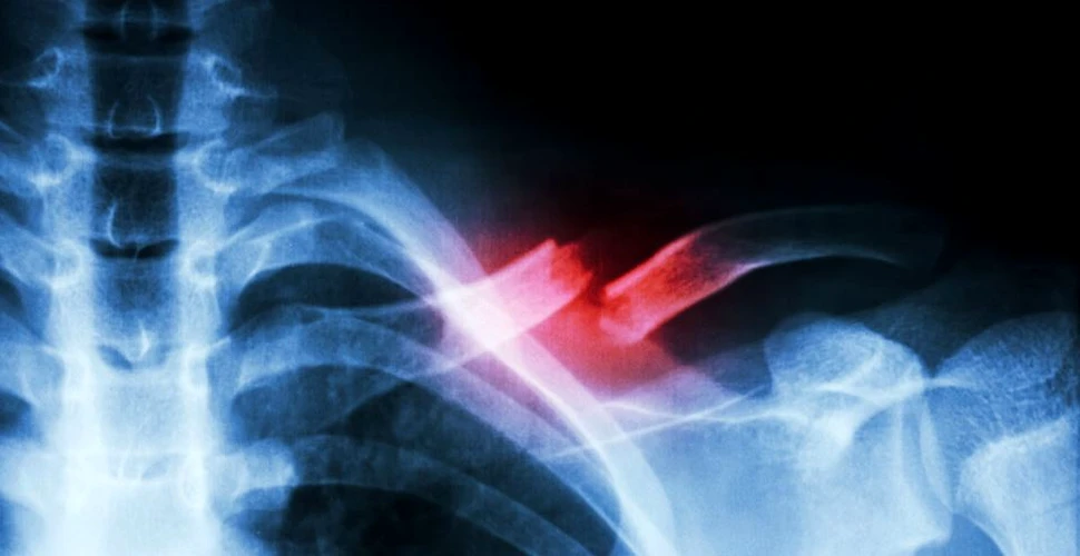 Cercetătorii au elaborat o metodă neobişnuită pentru tratarea fracturilor care va elimina complicaţiile cauzate de tijele metalice