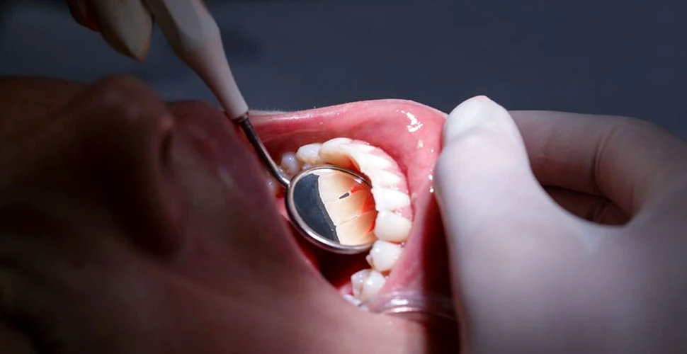 Un nou material dentar poate distruge bacteriile şi împiedică depunerea plăgii