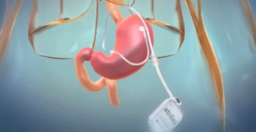 Cum să slăbeşti? Cu un pacemaker gastric! (VIDEO)