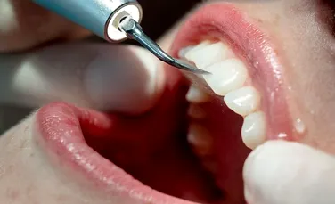De ce este important detartrajul regulat pentru prevenirea afecțiunilor gingivale (P)