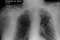 Un algoritm poate prezice cancerul pulmonar cu șase ani înainte de apariție