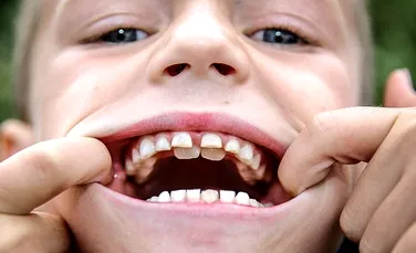 Copilul cu „dinţi de rechin”. Afecţiunea care îl face pe acest băieţel să arate ciudat