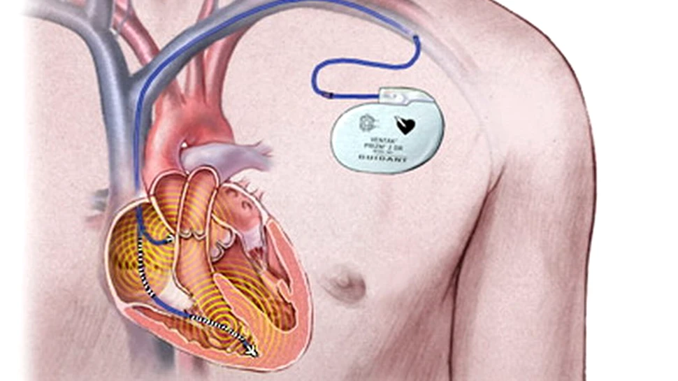 Pacemakerele si defibrilatoarele cardiace, vulnerabile la pirateria informatica