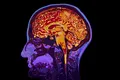 Cercetătorii au descoperit o genă care suprimă simptomele Alzheimerului