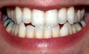 Adio implanturi dentare! În scurt timp vom înlocui dinţii lipsă cu „biodinţi” noi, care vor creşte direct în gura pacienţilor!