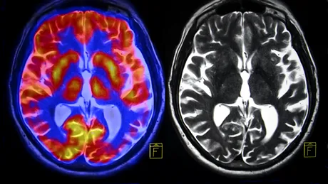 Bolile neurologice afectează mai mulți oameni decât s-a crezut până acum