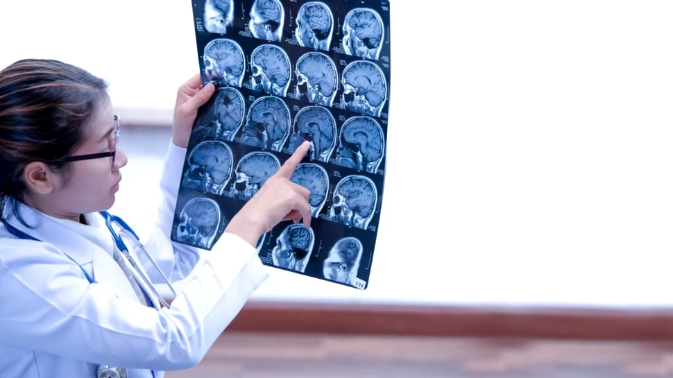 O metodă ingenioasă deschide o cale nouă de a detecta leziunile cerebrale după AVC