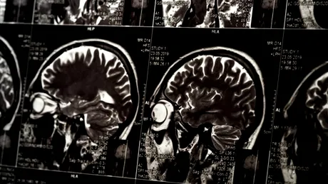 Au fost indentificate zonele din creier care ne ajută să ne amintim cuvinte