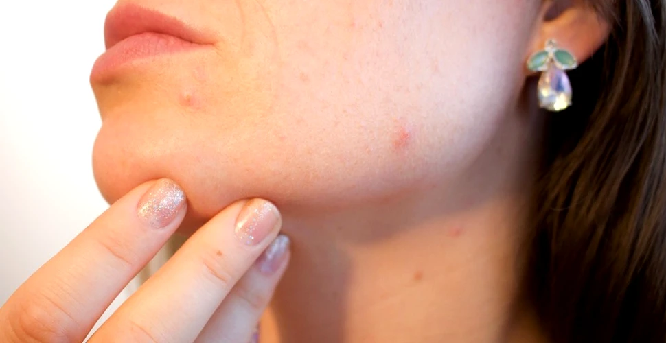 Există o legătură între acnee şi transpiraţie?