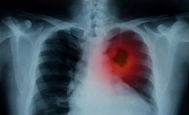 Premieră în medicină: un test de urină ar putea detecta cancerul pulmonar