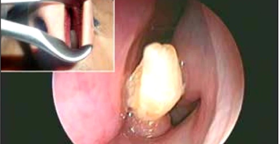 Medicii au descoperit un dinte în nasul unui bărbat care suferea de sângerări nazale (FOTO)