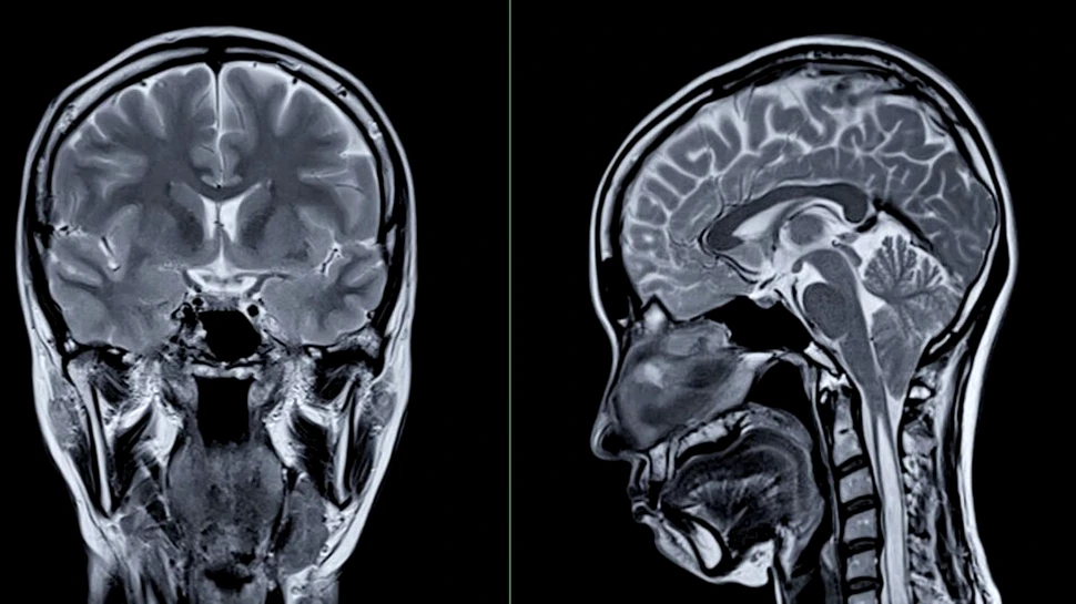 Sfatul neurologului: La ce obiceiuri să renunțăm pentru un creier sănătos?