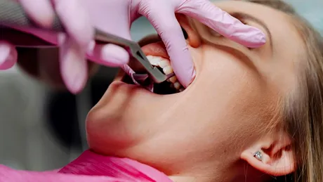 3 situații în care o persoană poate avea nevoie de chirurgie dentară (P)