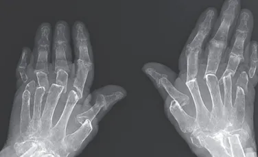 Caz medical neobişnuit: degetele unei femei se micşorează din cauza unei afecţiuni rare