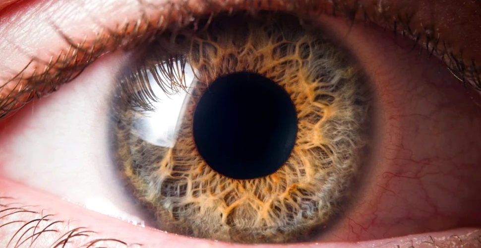 Inele de culoarea cuprului din ochii unui bărbat, indiciu pentru o boală foarte rară