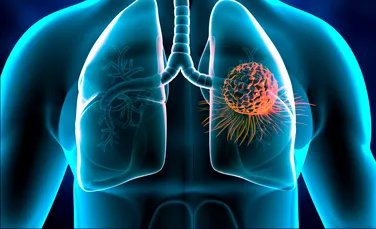 Oamenii de știință au descoperit cum declanșează poluarea cancerul pulmonar