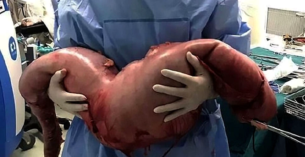Descoperire şocantă în corpul unui bărbat. Avea 13 kilograme şi reprezintă un caz rar în lumea medicală – FOTO