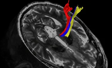 Tratamentul împotriva tremorului în boala Parkinson poate fi îmbunătățit cu o metodă avansată de scanare RMN