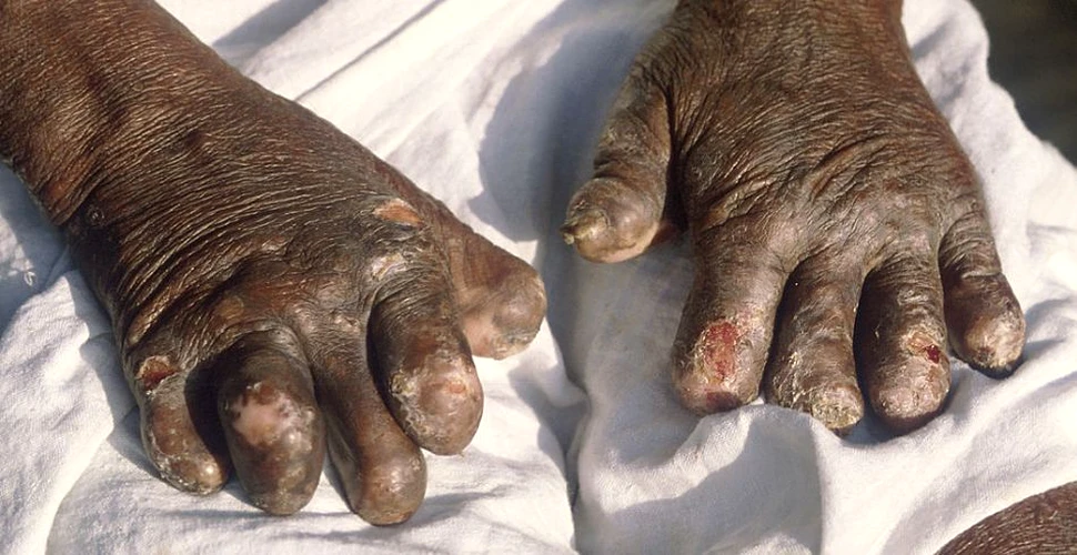 Care este cea mai veche boală infecţioasă a omului?