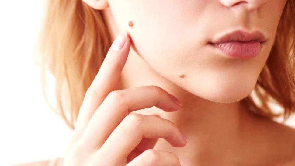 Test de cultură generală. De ce apar alunițele?