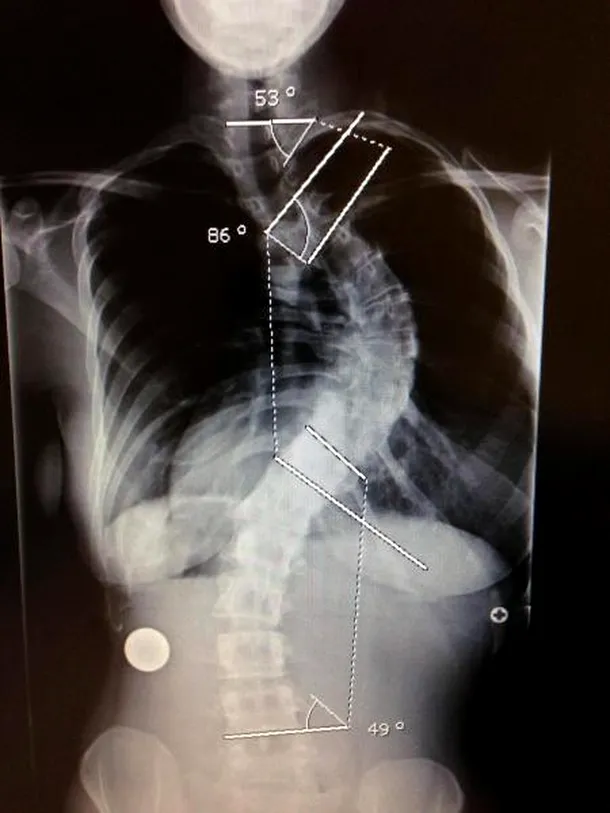 Radiografia coloanei, înainte de operaţie