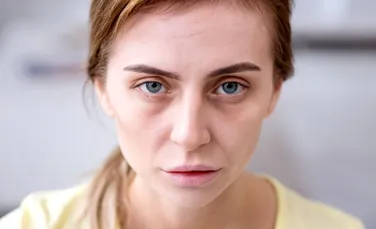 „Ferritin face”, noul termen viral de pe rețelele sociale. Ce legătură are cu deficitul de fier