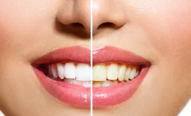 Trucurile simple care vă asigură un zâmbet perfect. Ce sfaturi dau stomatologii?