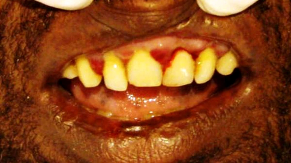 Numarul cazurilor de scorbut e in crestere in Marea Britanie