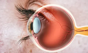 Primul implant de retină artificială efectuat de medicii din Italia