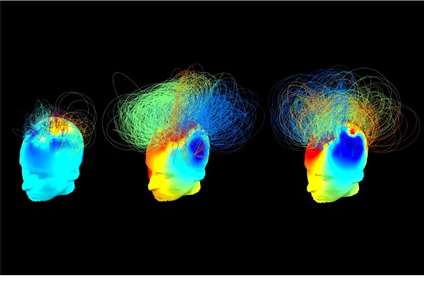 Activitatea cerebrală la trei persoane: cea din stânga şi cea din mijloc sunt în stare vegetativă, iar cea din dreapta este sănătoasă. Persoana din stânga este inconştientă, dar cea din mijloc, deşi nu poate comunica, este conştientă