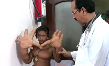 Mâinile acestui băieţel cântăresc 13 kilograme. Medicii spun că nu au mai văzut un asemenea caz (VIDEO)