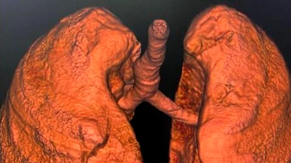 Tomografiile computerizate a 4 pacienți nevaccinați bolnavi de COVID-19, publicate de CNCAV