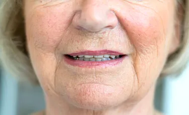 O femeie a primit un nas imprimat 3D crescut pe propriul braț