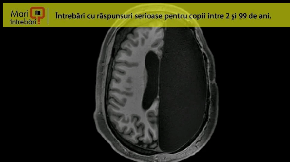 Cum poate funcţiona creierul dacă jumătate din acesta a fost extirpat?