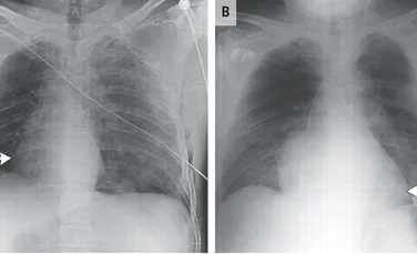 Când au văzut radiografia asta, medicilor nu le-a venit să creadă. Ce a păţit un bărbat, după un accident de motocicletă (FOTO)