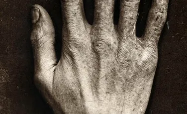 Şocant: Cum arăta mâna omului care a testat tuburi cu raze X pentru celebrul inventator Thomas Edison – FOTO