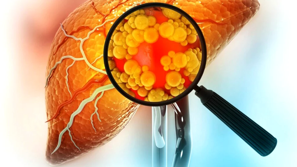 O formă severă de boală hepatică ar putea fi inversată de scăderea rapidă în greutate