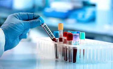 Grupa de sânge care poate crește riscul de accident vascular cerebral
