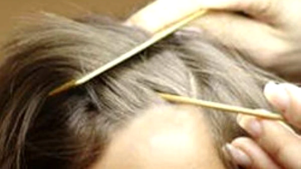 Nou tratament impotriva calvitiei
