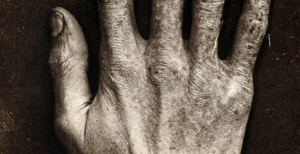 Şocant: Cum arăta mâna omului care a testat tuburi cu raze X pentru celebrul inventator Thomas Edison – FOTO