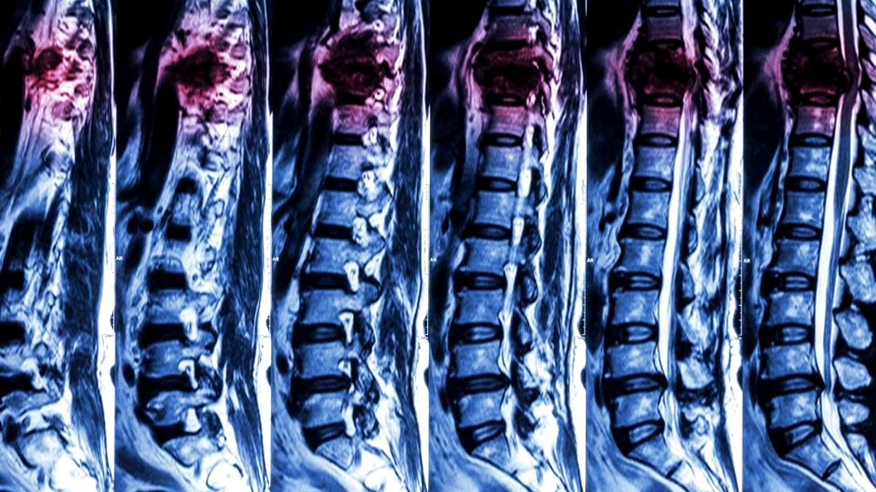 Savanţii au creat nanoparticule biodegradabile care pot trata leziunile la coloană. ”Noul tratament este neobişnuit”