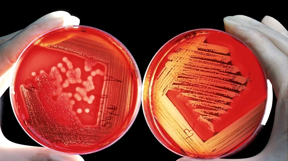 Un microbiom neobișnuit, identificat în cazul unor pacienți care suferă de hemoragii cerebrale