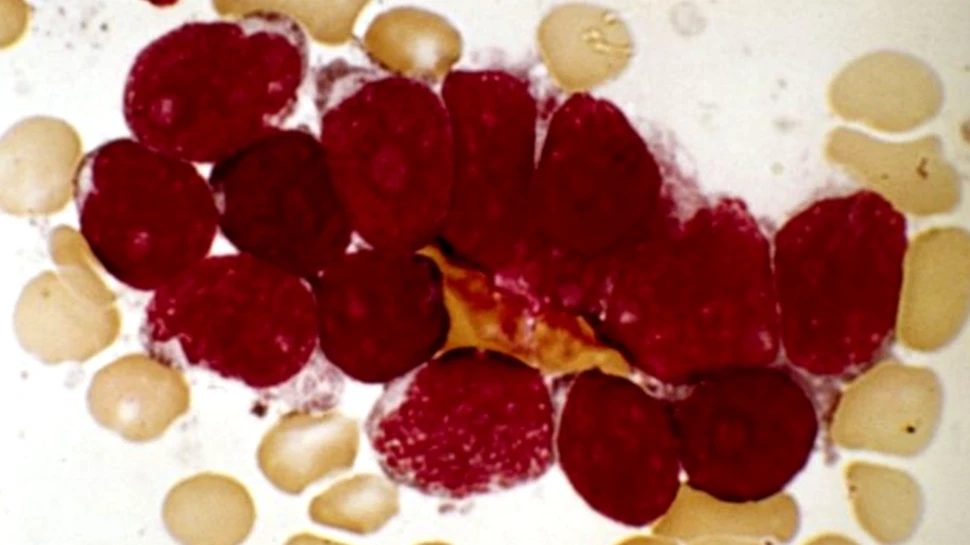 Premieră URIAŞĂ! Terapia revoluţionară care a SALVAT pacienţi aflaţi în faza terminală de cancer. ”Datele sunt fără precedent”. VIDEO