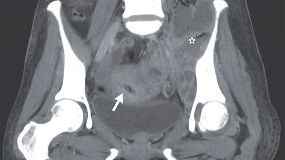 Femeia care a trăit timp de 20 de ani cu un sterilet în uter