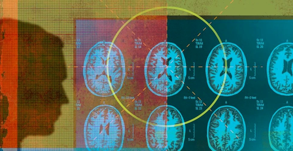 Un algoritm de inteligenţă artificială identifică tumorile cerebrale cu precizia unui specialist