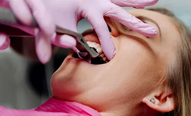 3 situații în care o persoană poate avea nevoie de chirurgie dentară (P)