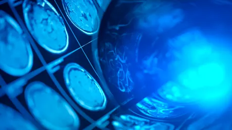O singură scanare cerebrală poate dezvălui cât de repede îmbătrânești