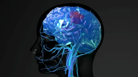 Medicii ar fi scos cu forța implantul cerebral al unei femei care suferă de epilepsie